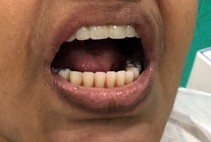 Fixed Teeth in 72 hours