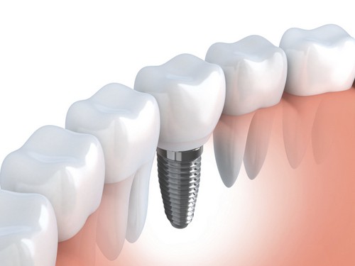 implant dentist in chennai